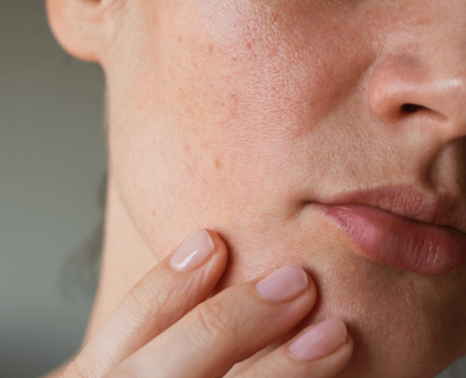 acne en la mujer adulta