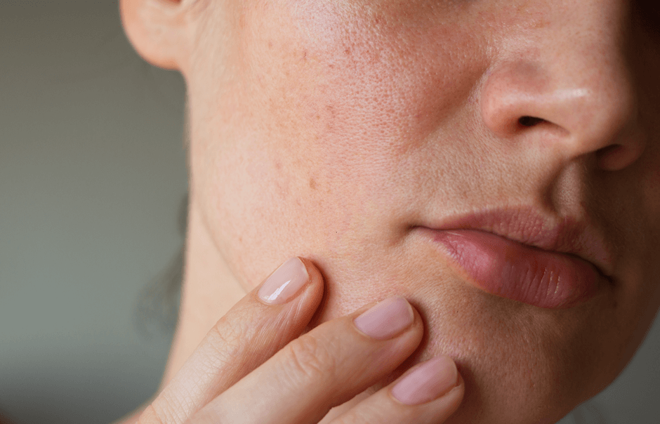 acne en la mujer adulta
