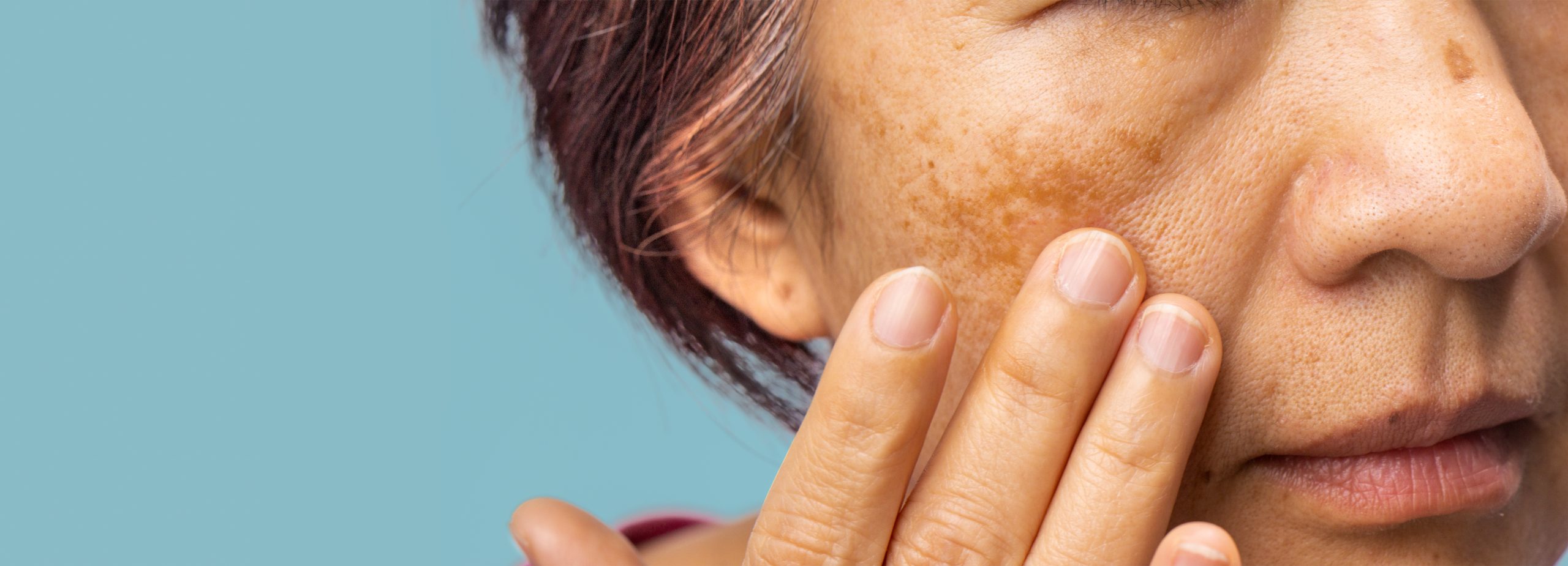 Menopausal women worry about melasma on face.
